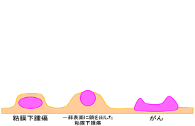 胃粘膜下腫瘍　図2