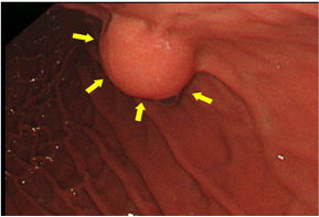 胃粘膜下腫瘍　図1